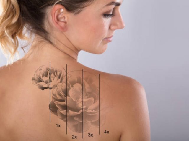 EVERYTHING YOU SHOULD KNOW BEFORE GETTING LASER TATTOO REMOVAL