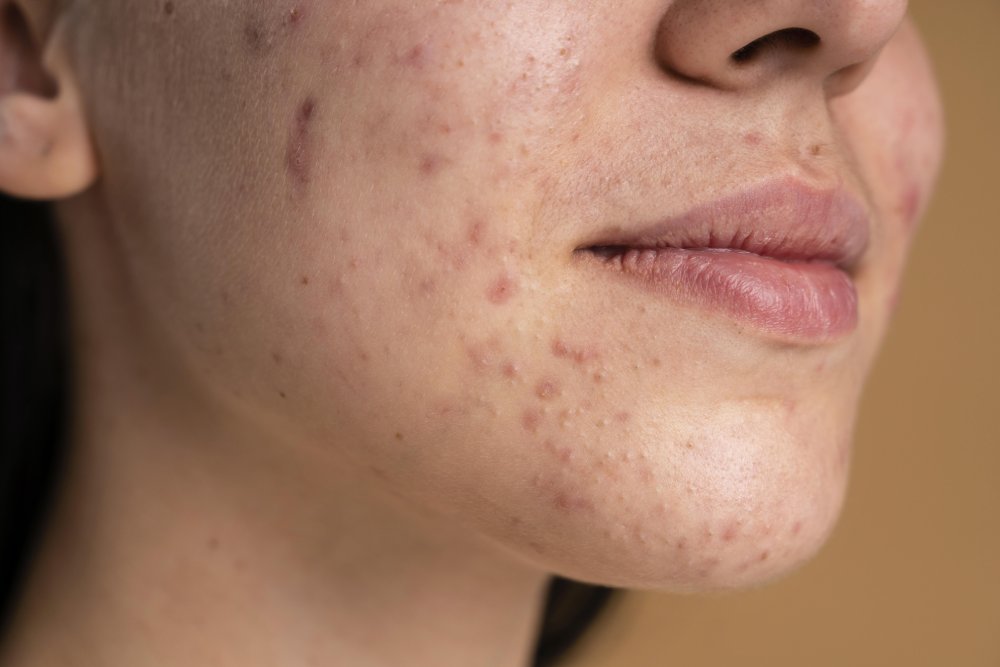 Acnes Scarring